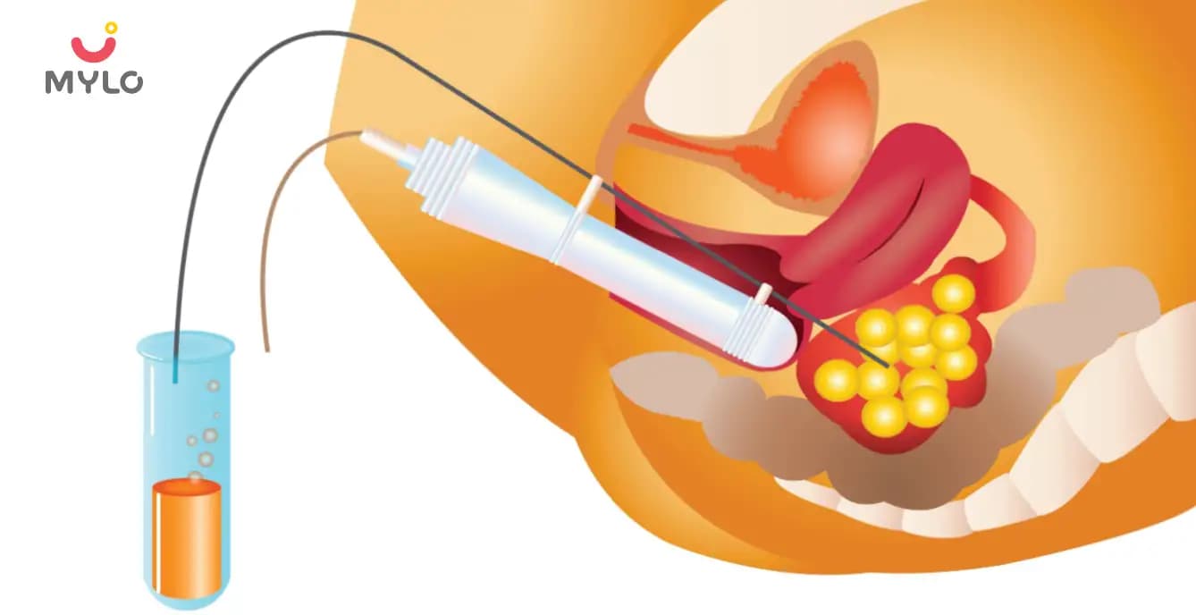 The Ultimate Guide to Egg Retrieval: Everything You Need to Know