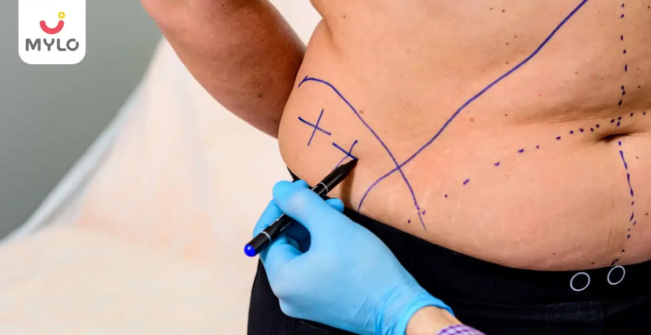 Tummy Tuck (Abdominoplasty) Procedure, Risks, Preparation & Recovery