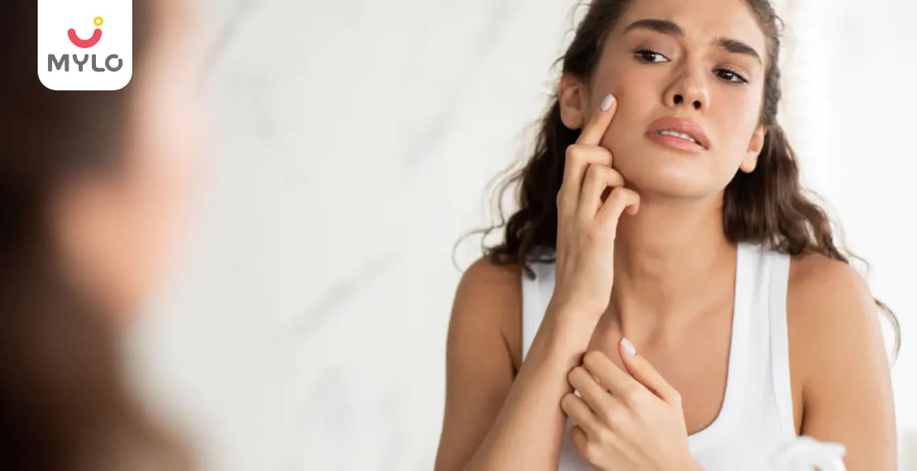 Causes of Acne in Hindi | आख़िर क्यों होते हैं एक्ने?