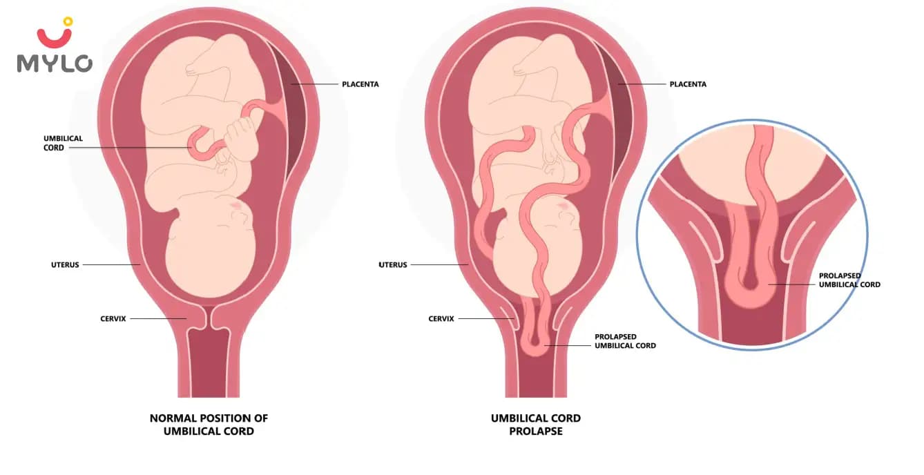 Umbilical Cord Prolapse Causes, Symptoms & Treatment