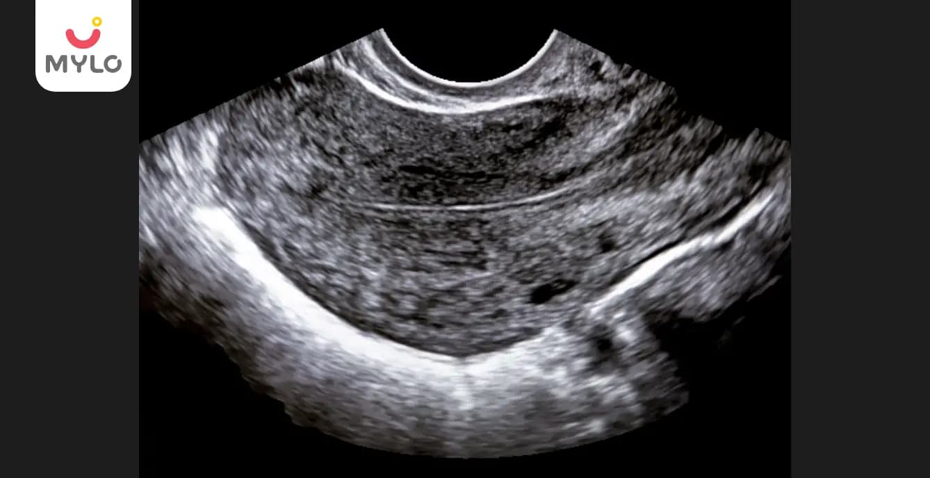 Endometrial Thickness in Pregnancy: Your Guide to Understanding What is Normal