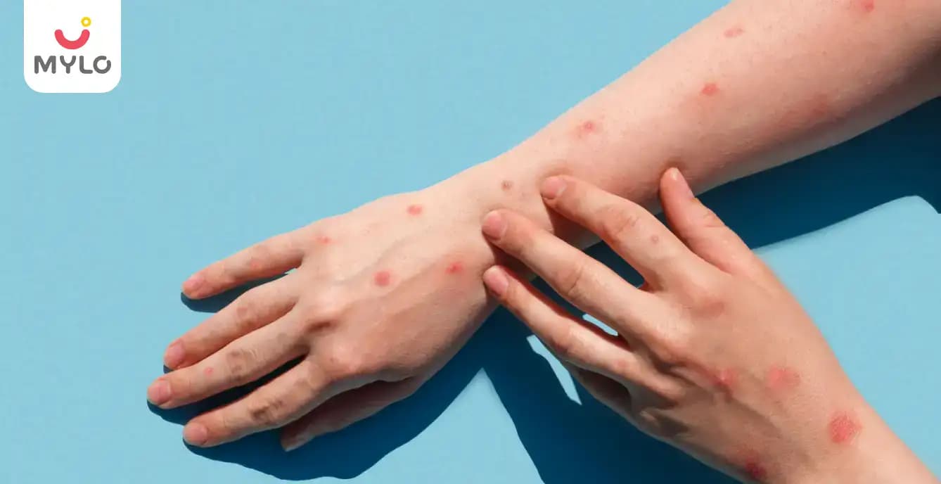 Prurigo of Pregnancy: Causes, Symptoms & Treatment