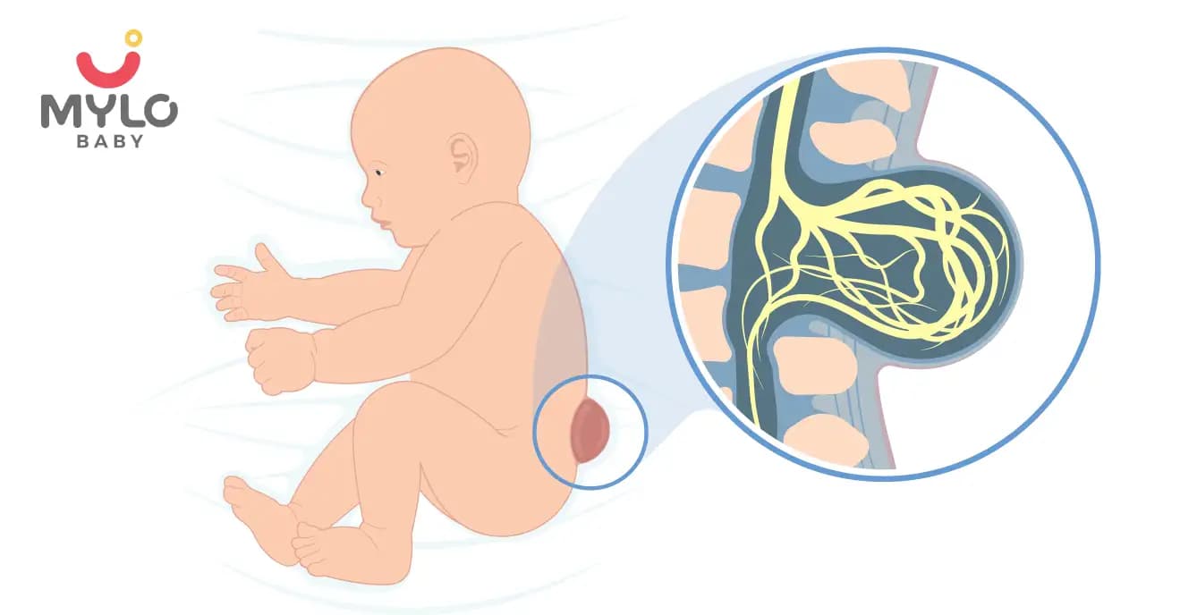 Spina Bifida: Causes, Symptoms & Treatment