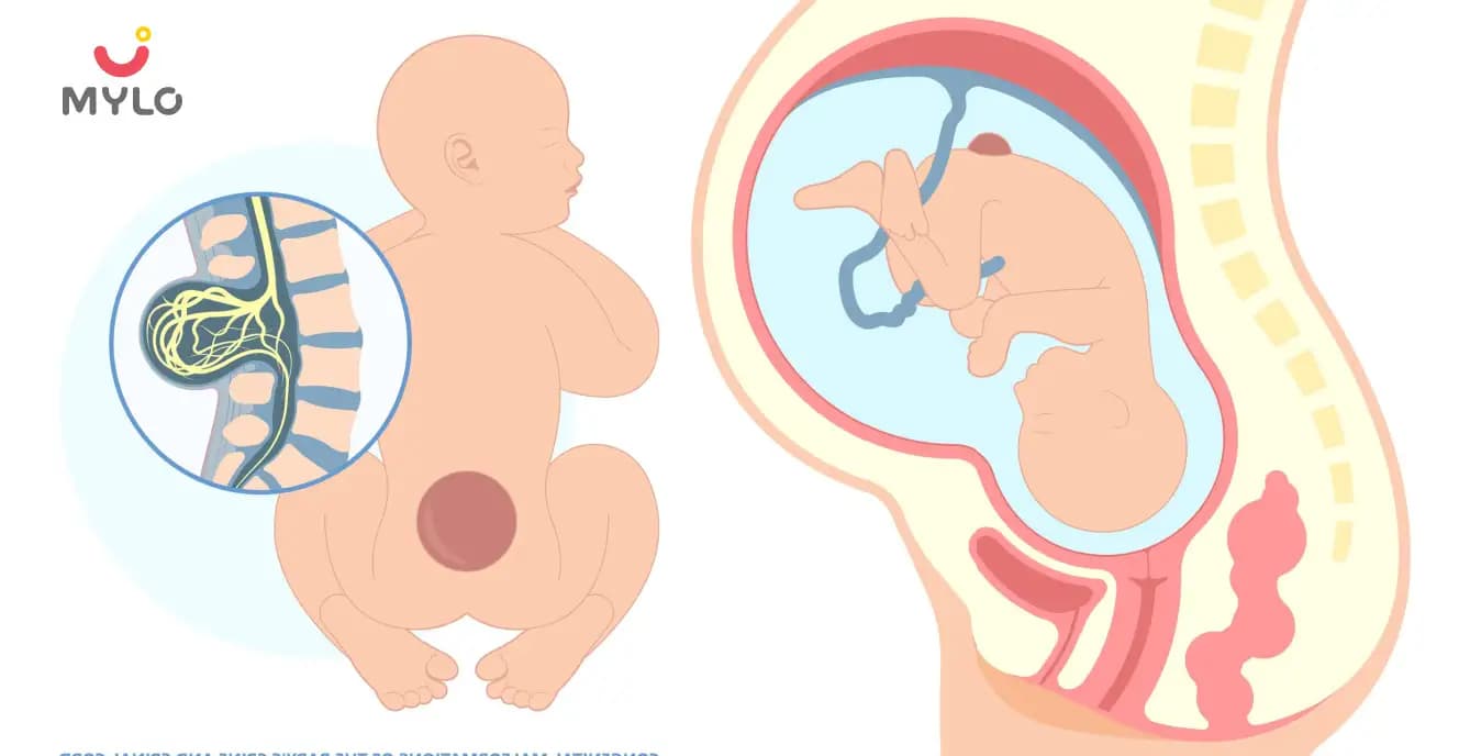 Myelomeningocele: Symptoms, Causes & Treatment