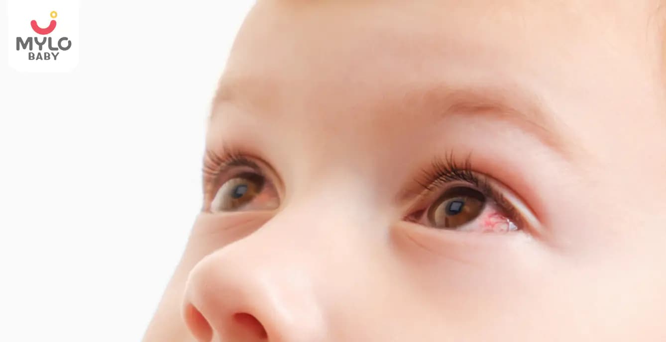 Eye Flu Alert: The Seasonal Epidemic You Need to Know About