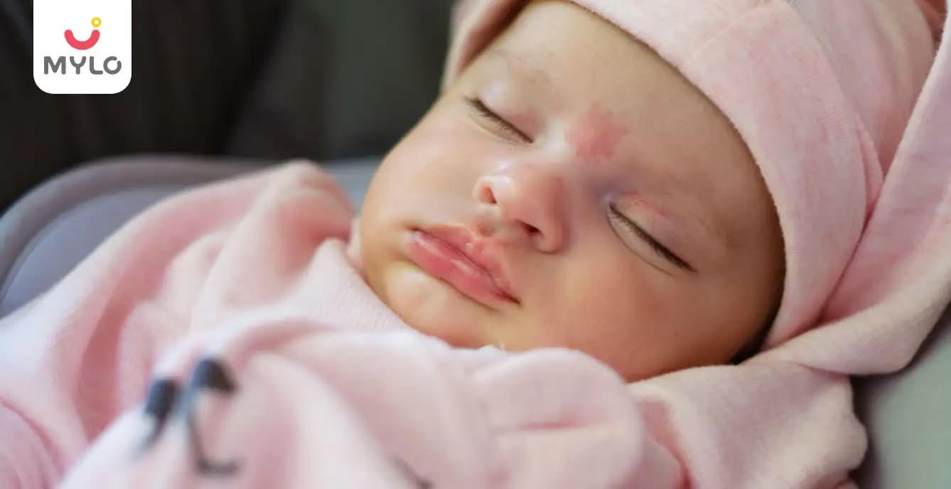 Port Wine Stain Birthmark: Symptoms, Causes & Treatment