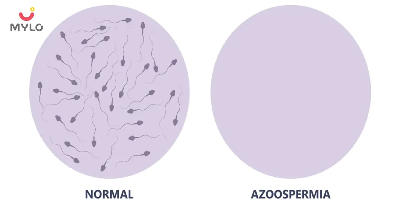 Azoospermia Meaning in Hindi | पुरुषों से पिता बनने का सुख छीन सकता है एजुस्पर्मिया!  