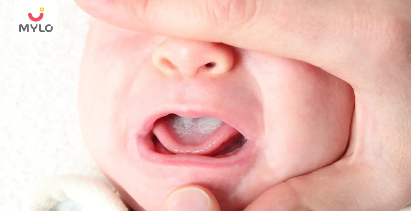 Baby's Mouth Thrush (Oral Thrush in Babies): Symptoms, Causes, Treatment and Home Care Guide (2026)