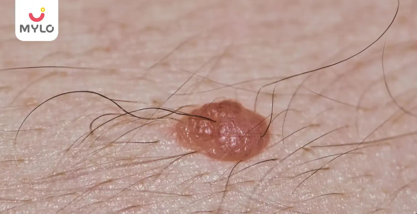 Giant Congenital Melanocytic Nevus: Causes, Symptoms, & Treatment 