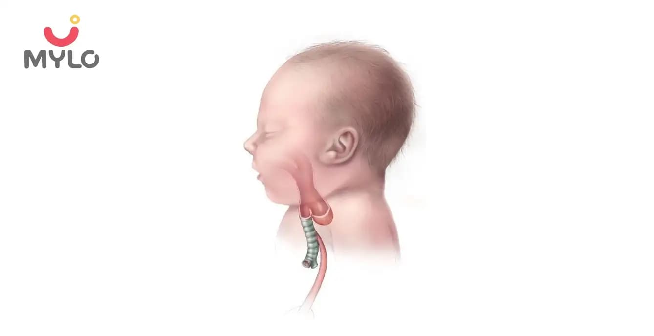 Tracheoesophageal Fistula: Causes, Symptoms, Risks & Treatment