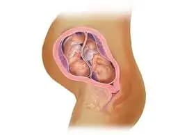 What are the common health conditions that you should be aware about when expecting more than one baby? 