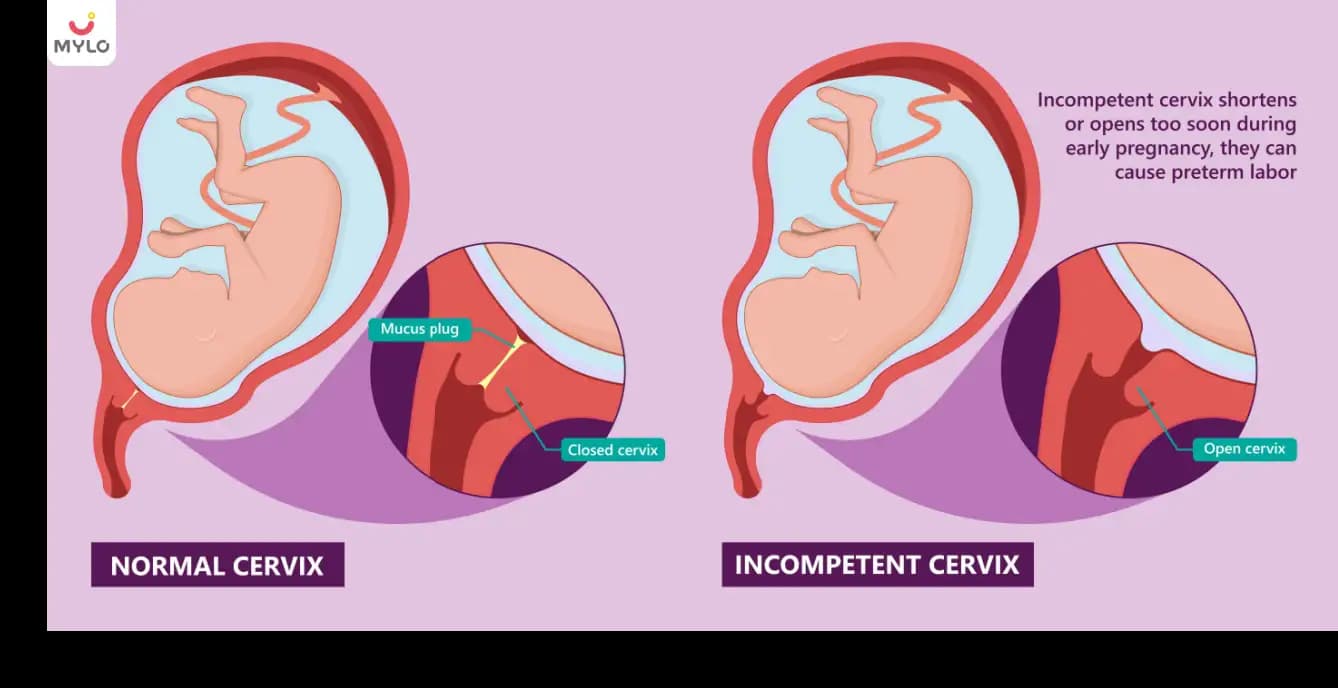 Incompetent cervix: Causes, Symptoms, & Treatment