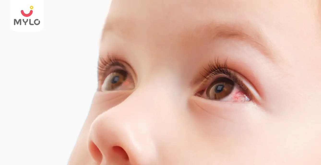 Eye flu in Hindi | तेज़ी से फैल रहा है आई फ्लू, जानें क्या हैं इसके शुरुआती लक्षण 