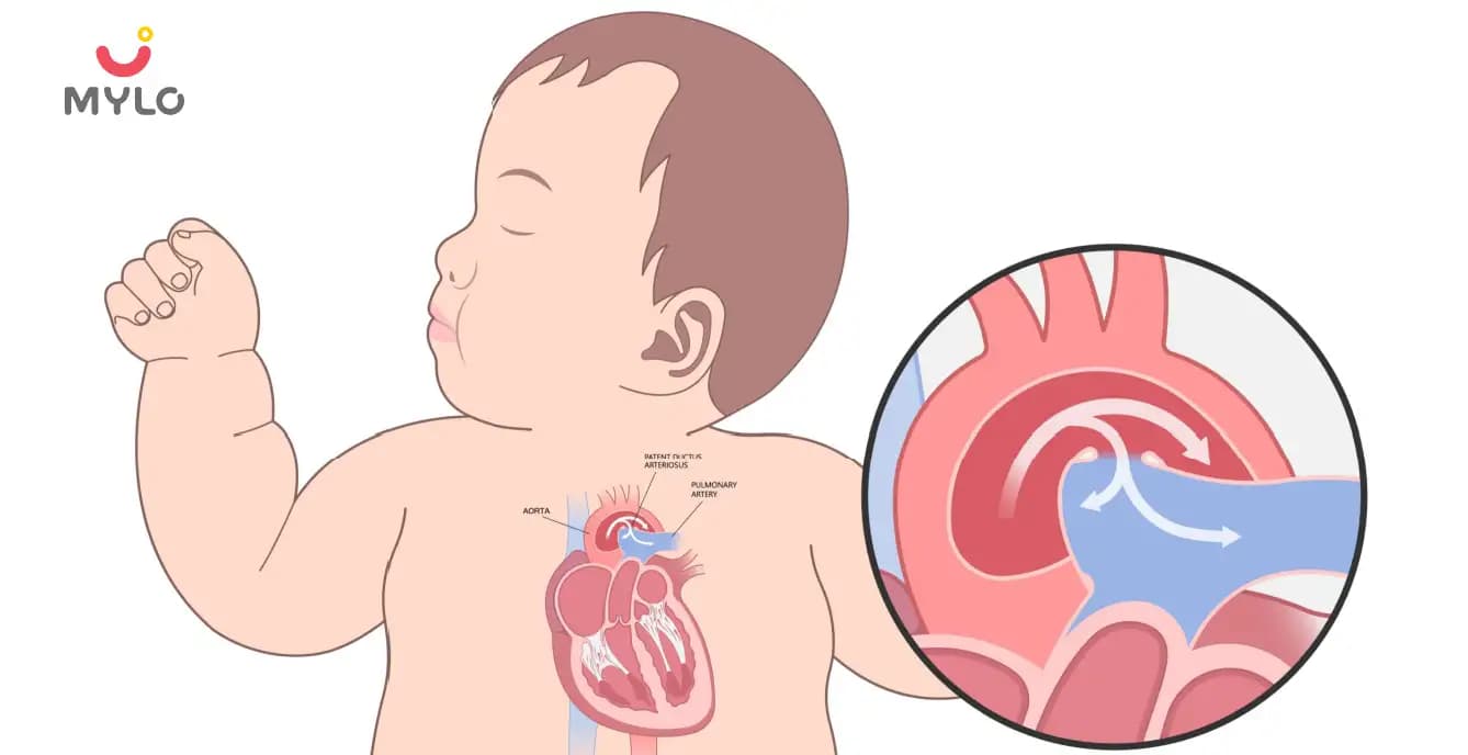 Patent Ductus Arteriosus (PDA) Symptoms & Treatment