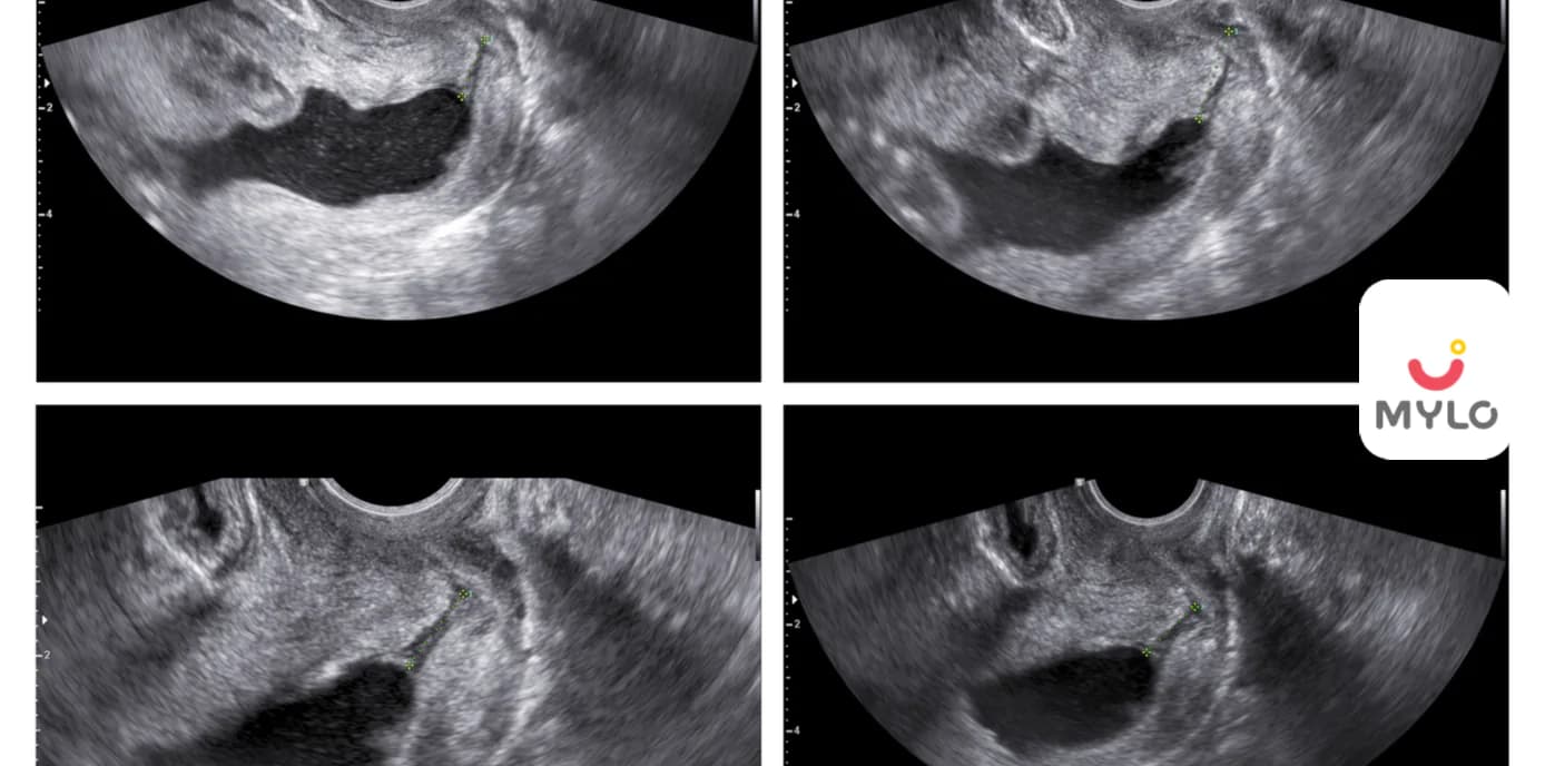 Anomaly Scan: The Ultimate Guide for Expecting Parents