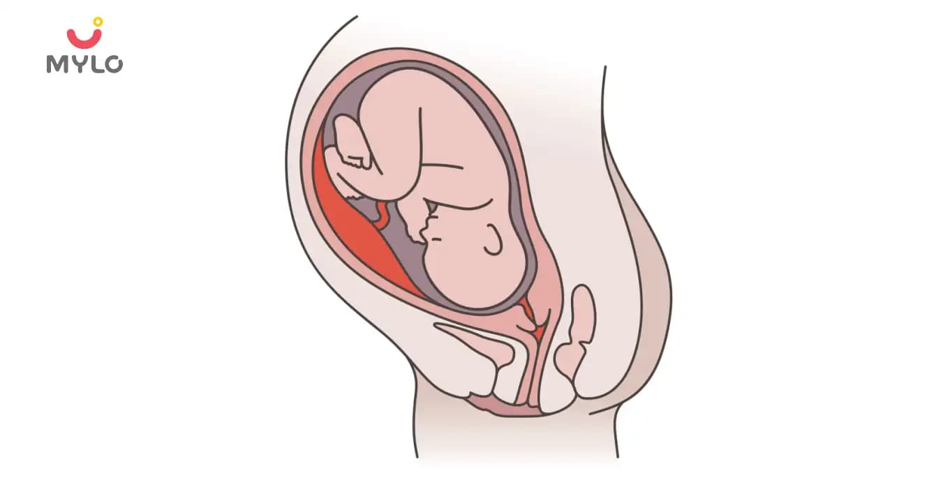 Velamentous Cord Insertion - Precautions, Results & Safety