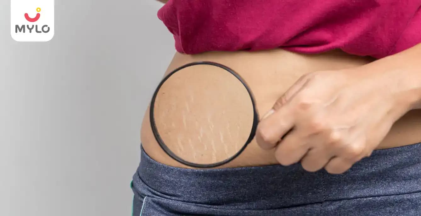 Weight Loss & Stretch Marks: Your Quick Guide