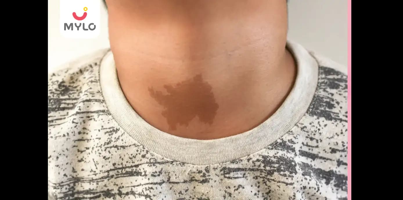 Birthmark: Types, Causes, Risks & Treatment