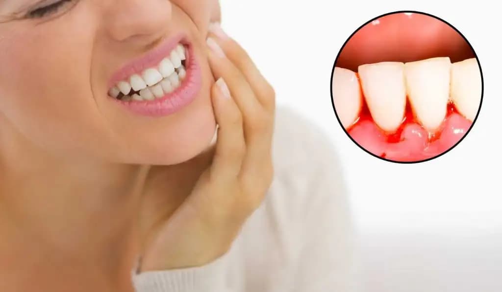 10 Home Remedies To Treat Bleeding Gums