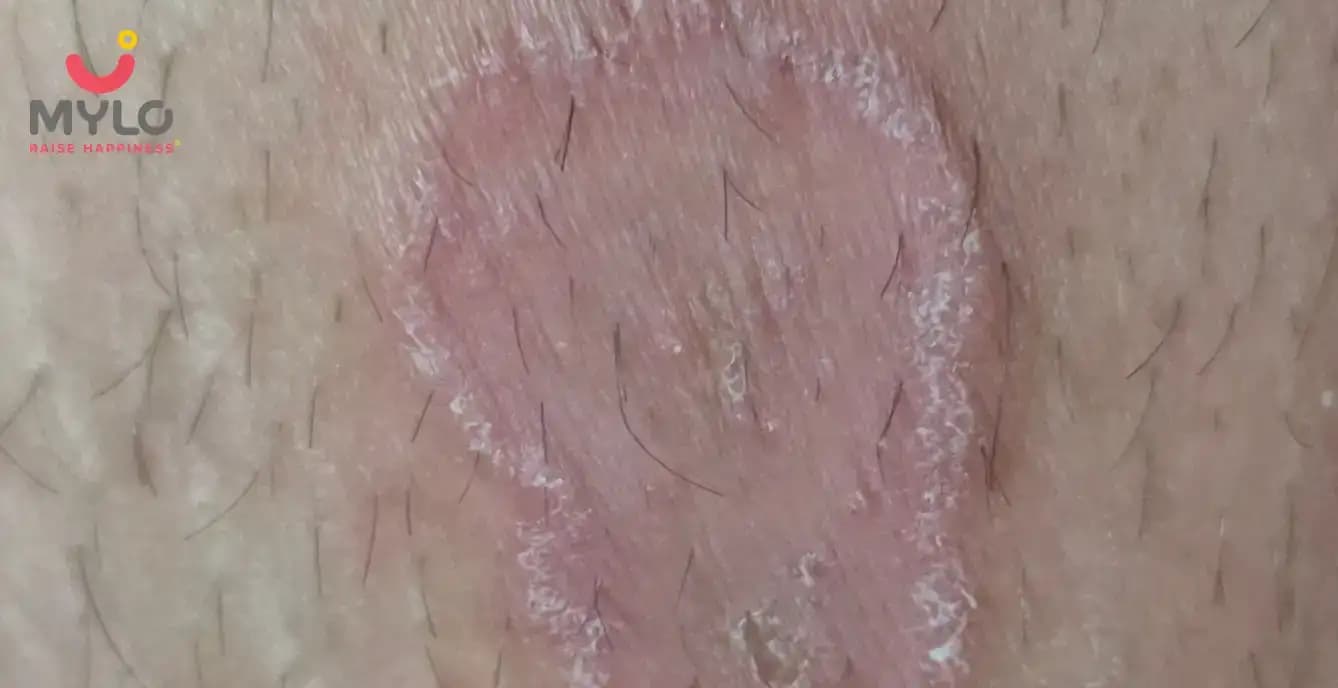 How to cure ringworm in toddlers