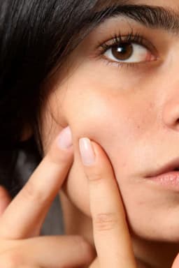 Skin Pigmentation, Melasma or The 'Mask of Pregnancy'