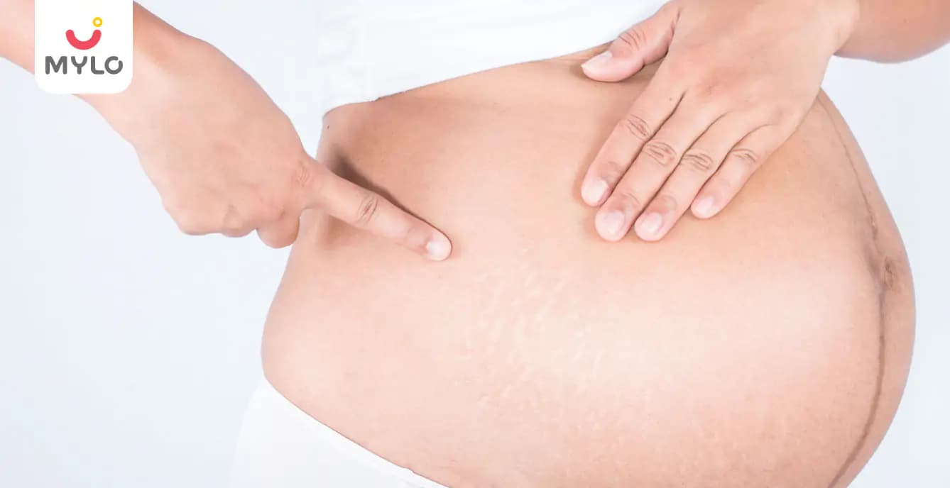 Top 5 Reasons and Remedies for Stretch Marks During Pregnancy
