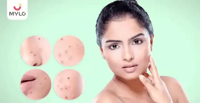 முகப்பரு பாதிப்புள்ள சருமத்தை குணப்படுத்த வைட்டமின்-சி ஏற்றதா? (Is Vitamin-C a healing agent for acne-prone skin In Tamil) 