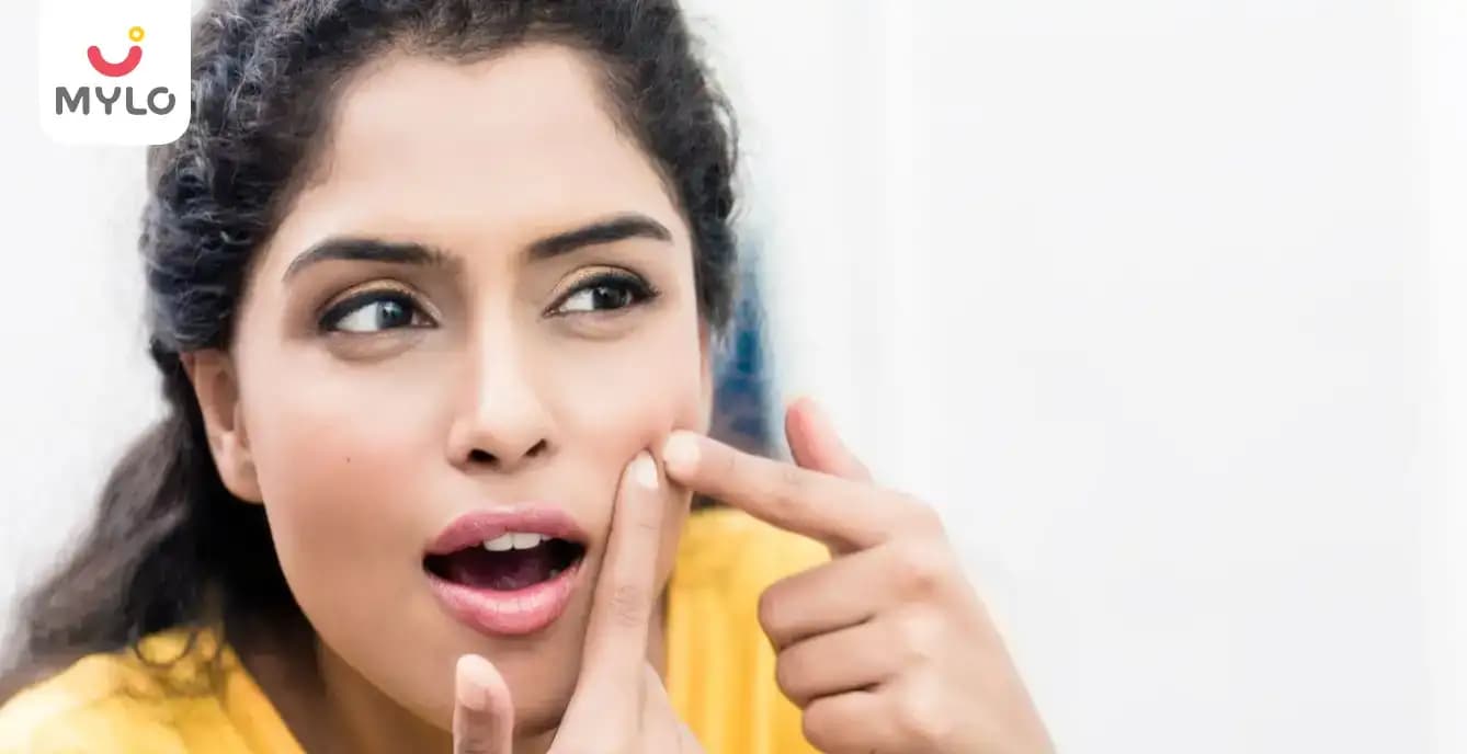 আপনার ত্বক থেকে ব্রণ দূর করার জন্য  5 টি সেরা প্রাকৃতিক উপায়