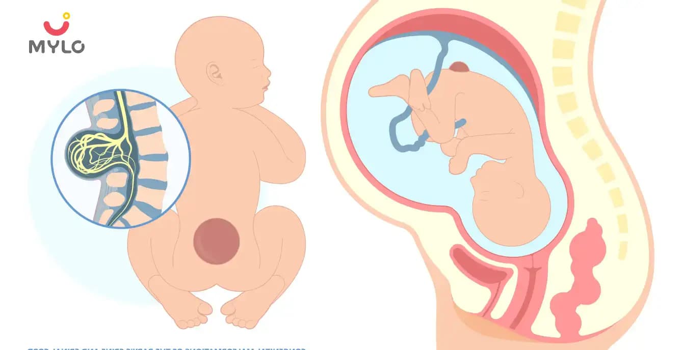 Myelomeningocele: লক্ষণ, কারণ, এবং চিকিত্সা
