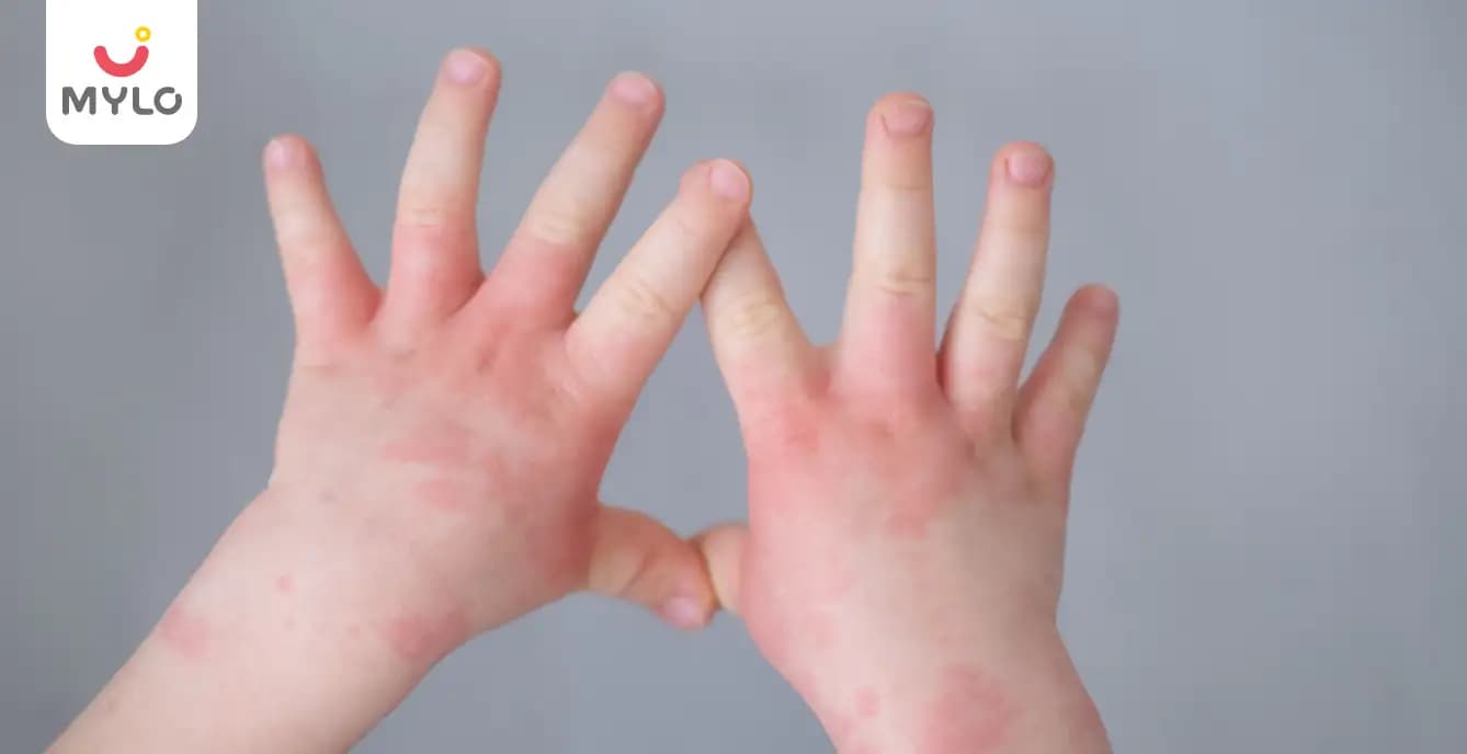 CMPA (Cow's Milk Protein Allergy): Identifying Symptoms and Understanding Treatment