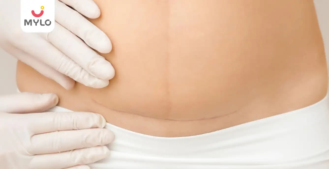 When Can I Start Bending After C-Section: Expert Insights on C-Section Recovery