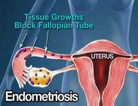 All about Infertility Solutions