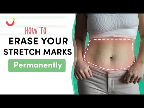 How to Get Rid of Stretch Marks Permanently | Natural Ways to Fade Stretch Marks with Home Remedies