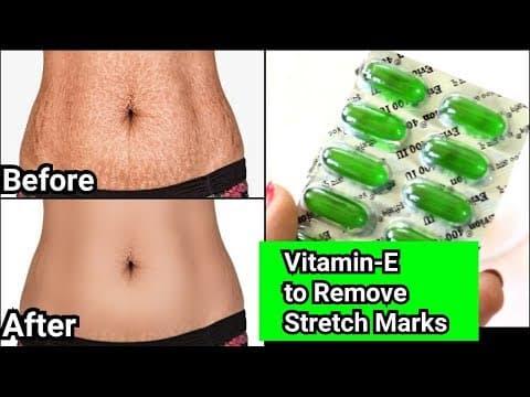 Easy tricks to remove stretch marks at home ?? do watch this video to get rid of stretch marks problems ?