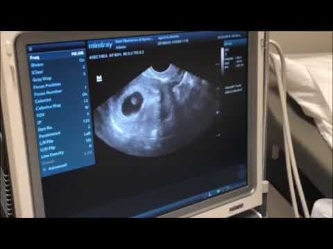 6weeks  pregnancy  ultrasound