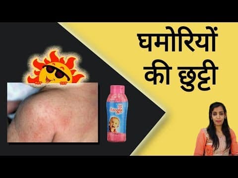 Bacho ki body mei lal rang k daane kiu hote hai. Eska reason aur eska treatment janne es vdo mei. For more information baby health subscribe my YouTube channel helpingmumma.