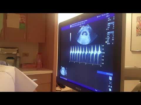 6weeks   baby  ultrasound