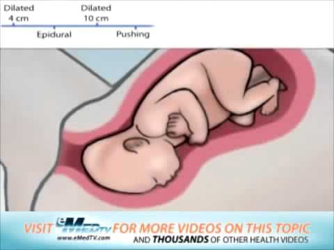Labor and Delivery - Hospital Induction - IUGR Baby