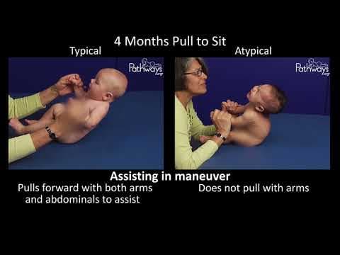 Difference between Typical and Atypical motor development in  months old baby