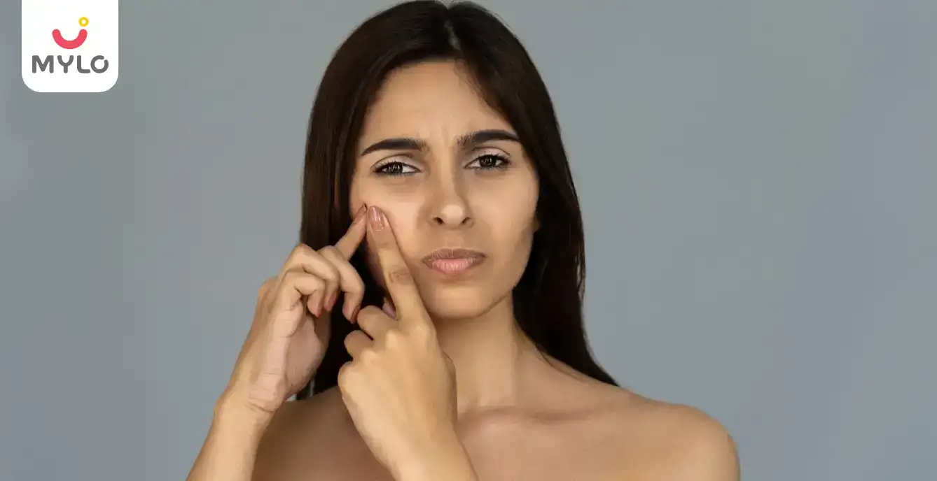 ত্বক থেকে ব্রণ দূর করার শীর্ষ ৫ টি উপায় |Top 5 Ways to Rid Acne from the Skin in Bengali