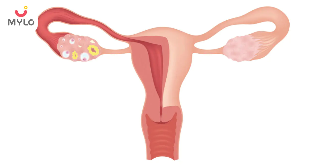 Polycystic Ovarian Disease (PCOD): Causes, Symptoms, And Treatment