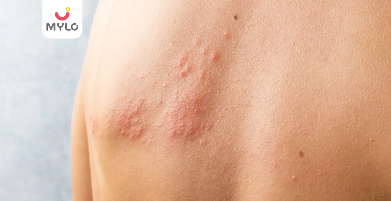 హెర్పెస్: కారణాలు, లక్షణాలు, ప్రమాదం & చికిత్స 