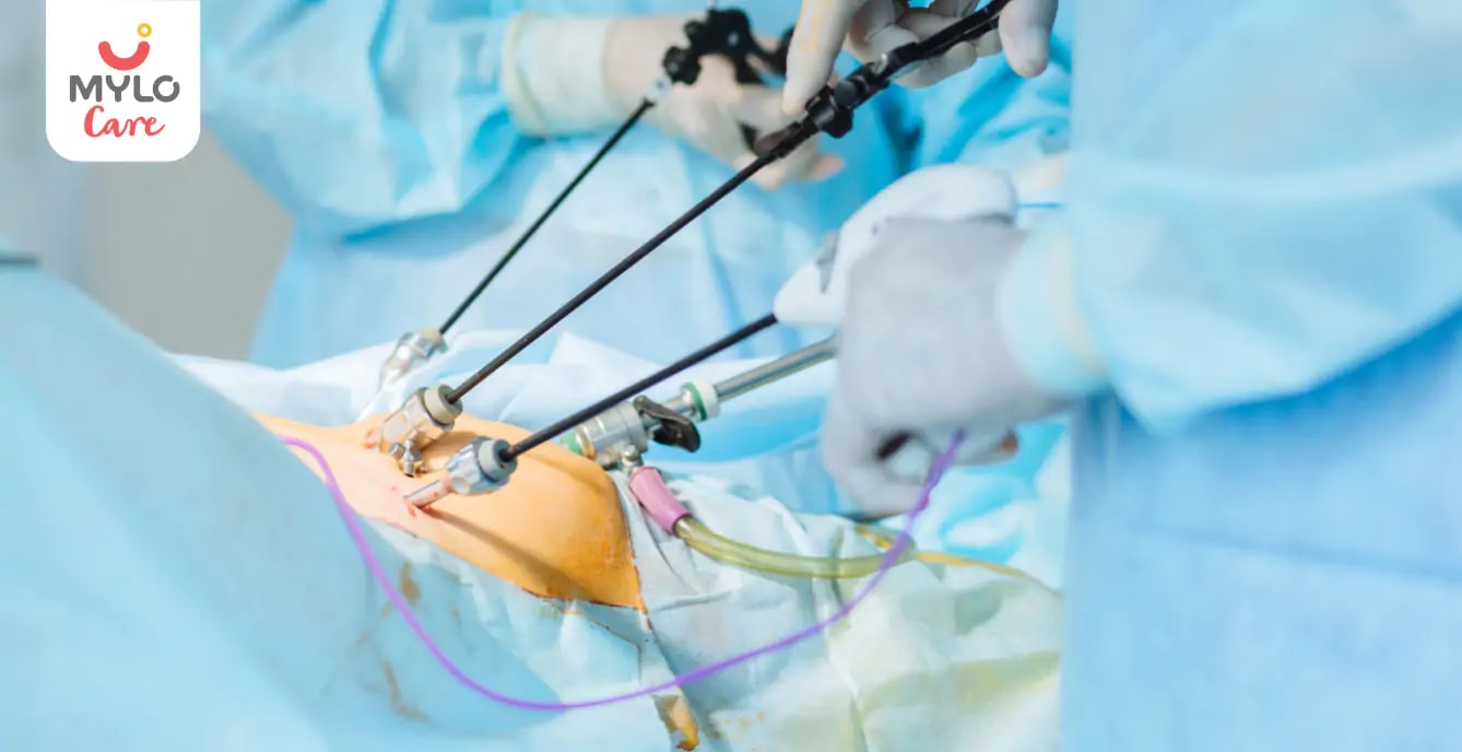 ল্যাপারোস্কোপিক ওভারিয়ান ড্রিলিং: PCOS-সম্পর্কিত বন্ধ্যাত্বের জন্য একটি নিরাপদ এবং কার্যকর সমাধান |Laparoscopic Ovarian Drilling: A Safe and Effective Solution for PCOS-Related Infertility in Bengali