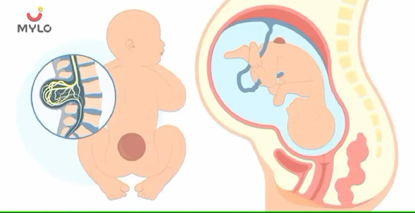  மைலோமென்னின்கோசெல் அறிகுறிகள், காரணங்கள் மற்றும் சிகிச்சை(Myelomeningocele: Symptoms, Causes, and Treatment In tamil)