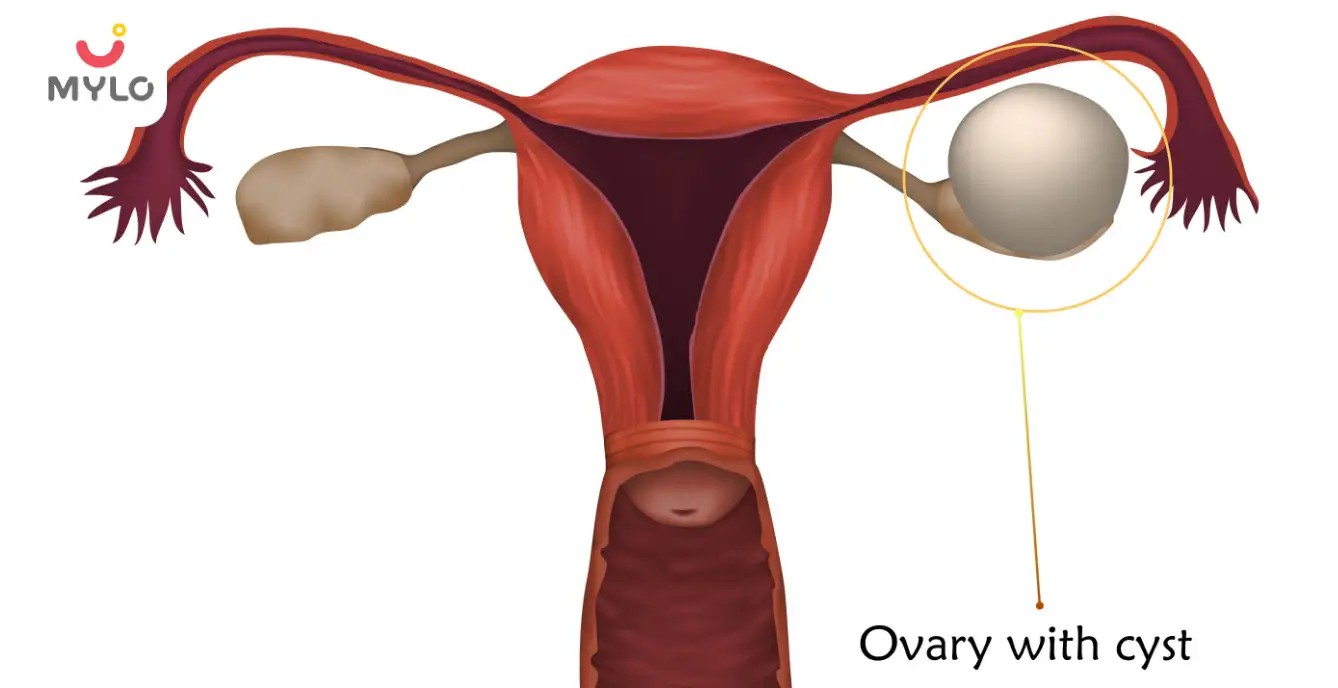 How to Get Pregnant with Ovarian Cysts: Unlocking Parenthood