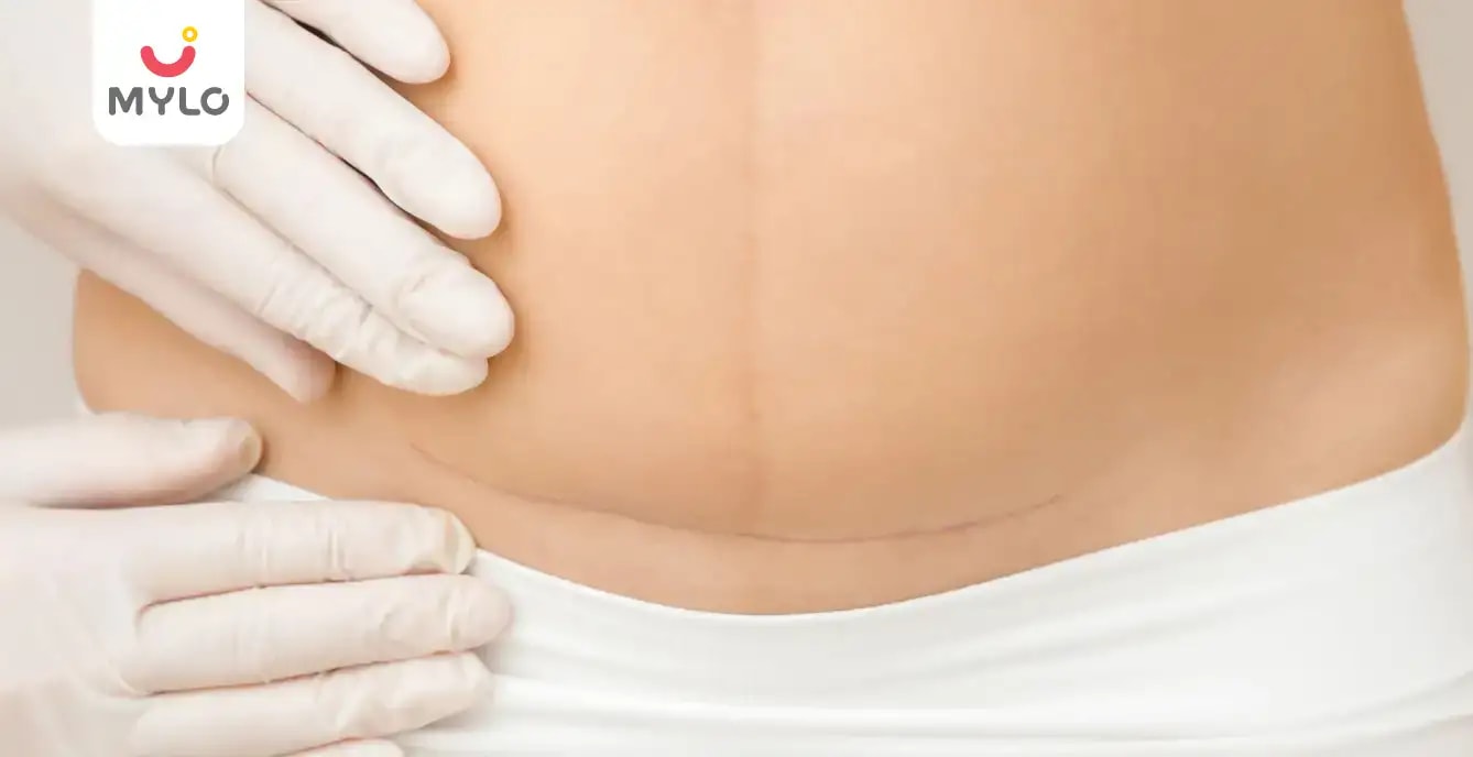 Images related to  சி-செக்‌ஷனுக்குப் பிறகு நான் எப்போது குனிய வேண்டும்?