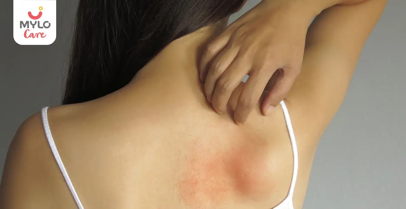 Images related to গর্ভাবস্থায় ফুসকুড়ি: কারণ, লক্ষণ এবং প্রতিরোধ | Heat Rash During Pregnancy: Causes, Symptoms and Prevention in Bengali