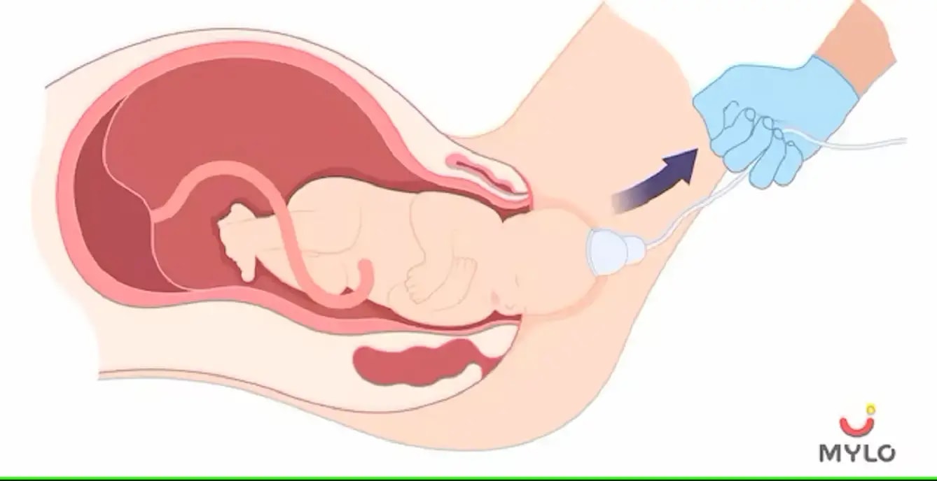 கர்ப்பமாக இருக்கும்  பெண்கள் வேக்யூம்  பிரசவம் (vacuum delivery) பற்றி தெரிந்து கொள்ள வேண்டிய விஷயங்கள் (Things Pregnant Women Should Know About Vacuum Delivery  In Tamil)