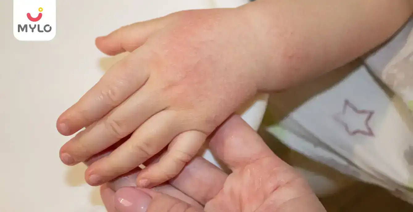 Images related to కవాసాకి వ్యాధి (ధమనుల వాపు): అంటే ఏమిటి, దాని లక్షణాలు, చికిత్స