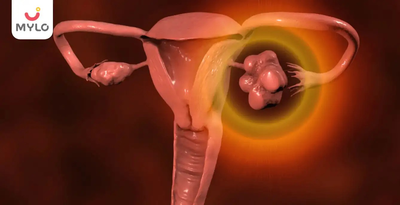 PCOD Ke Lakshan in Hindi | आख़िर कैसे होते हैं पीसीओडी के लक्षण? 